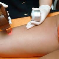 Que dois-je faire avant et après une séance d’épilation laser ?