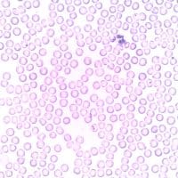 Leucocytes élevés : les maladies qui font varier leur taux